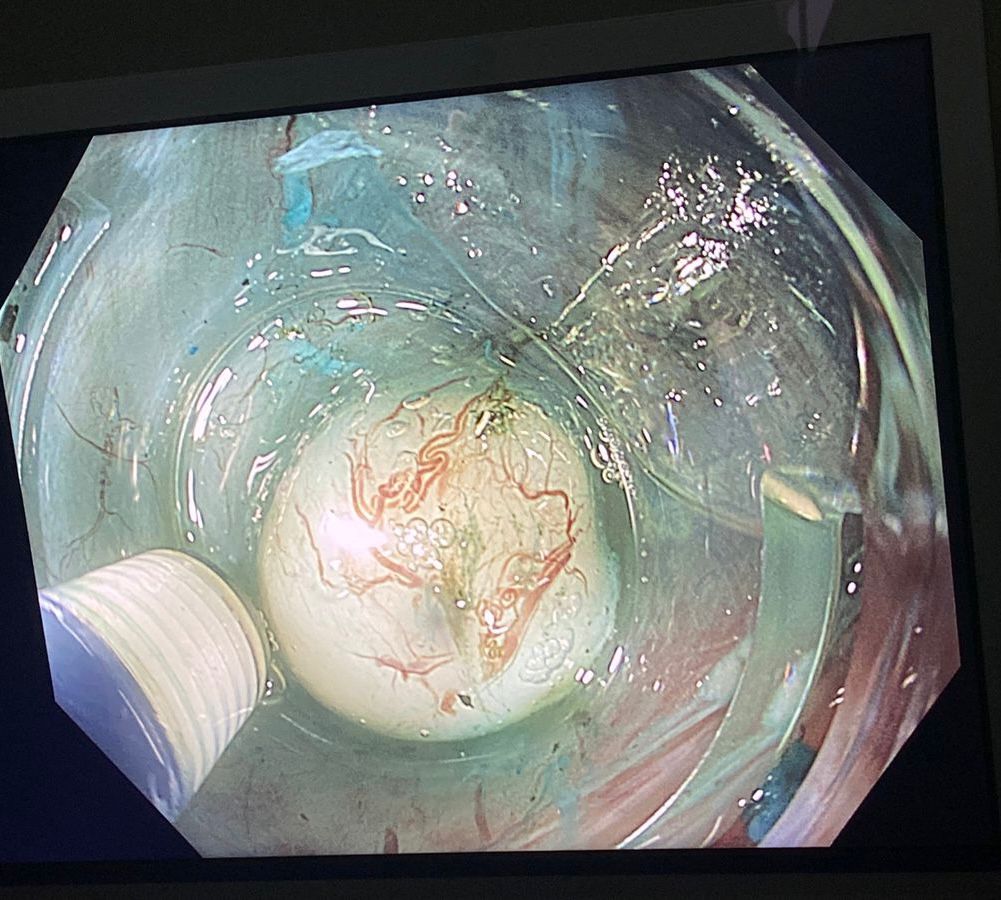 جامعة حلوان تنفذ أول عملية لاستئصال ورم بالمريء باستخدام منظار الموجات فوق الصوتية