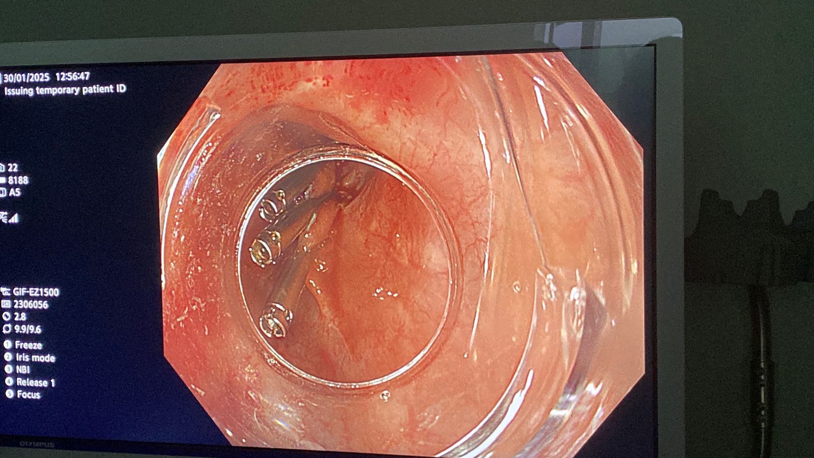 جامعة حلوان تنفذ أول عملية لاستئصال ورم بالمريء باستخدام منظار الموجات فوق الصوتية