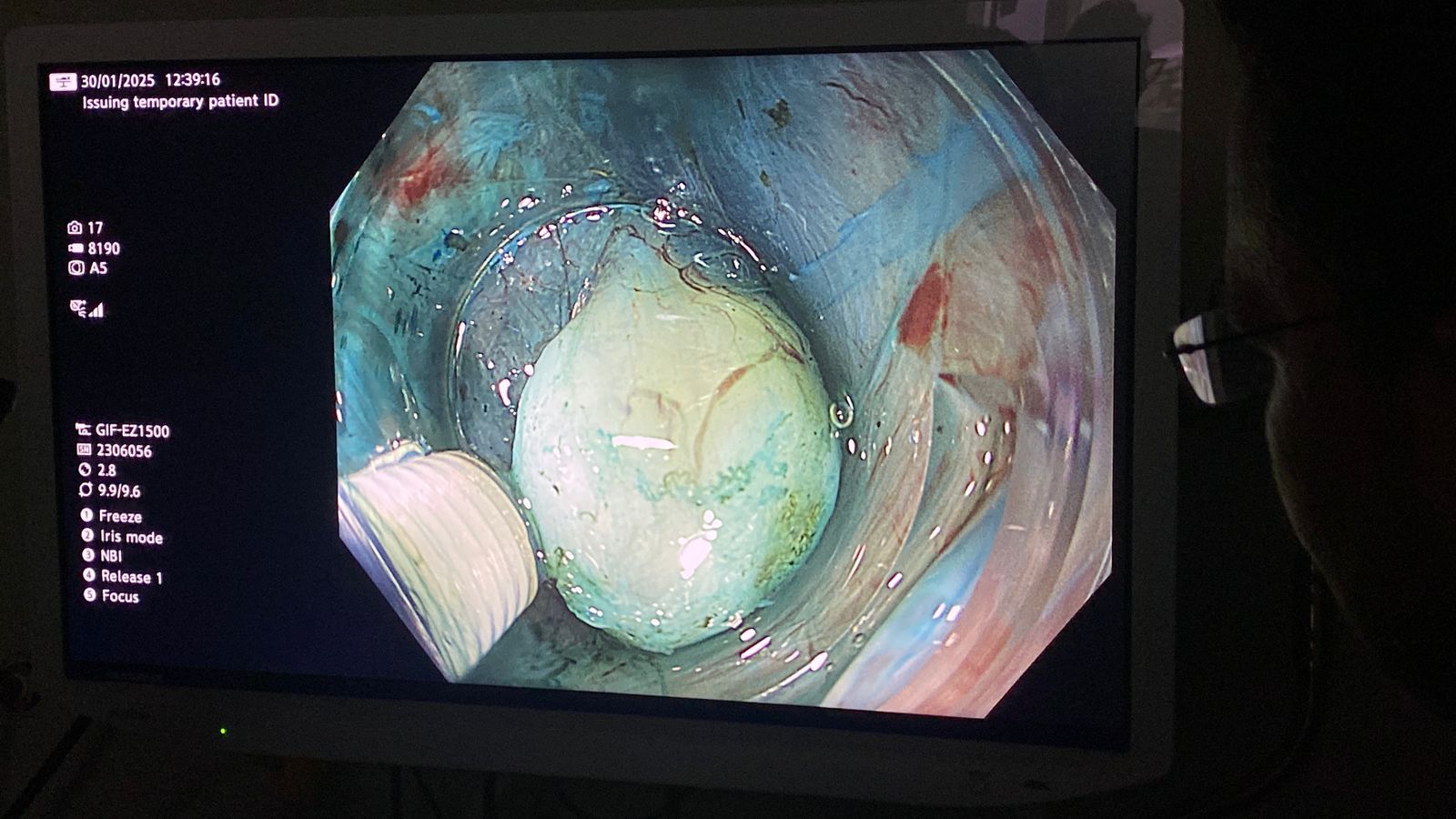 جامعة حلوان تنفذ أول عملية لاستئصال ورم بالمريء باستخدام منظار الموجات فوق الصوتية