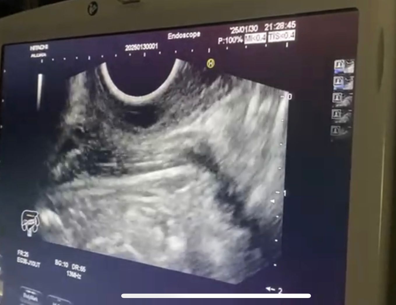 جامعة حلوان تنفذ أول عملية لاستئصال ورم بالمريء باستخدام منظار الموجات فوق الصوتية