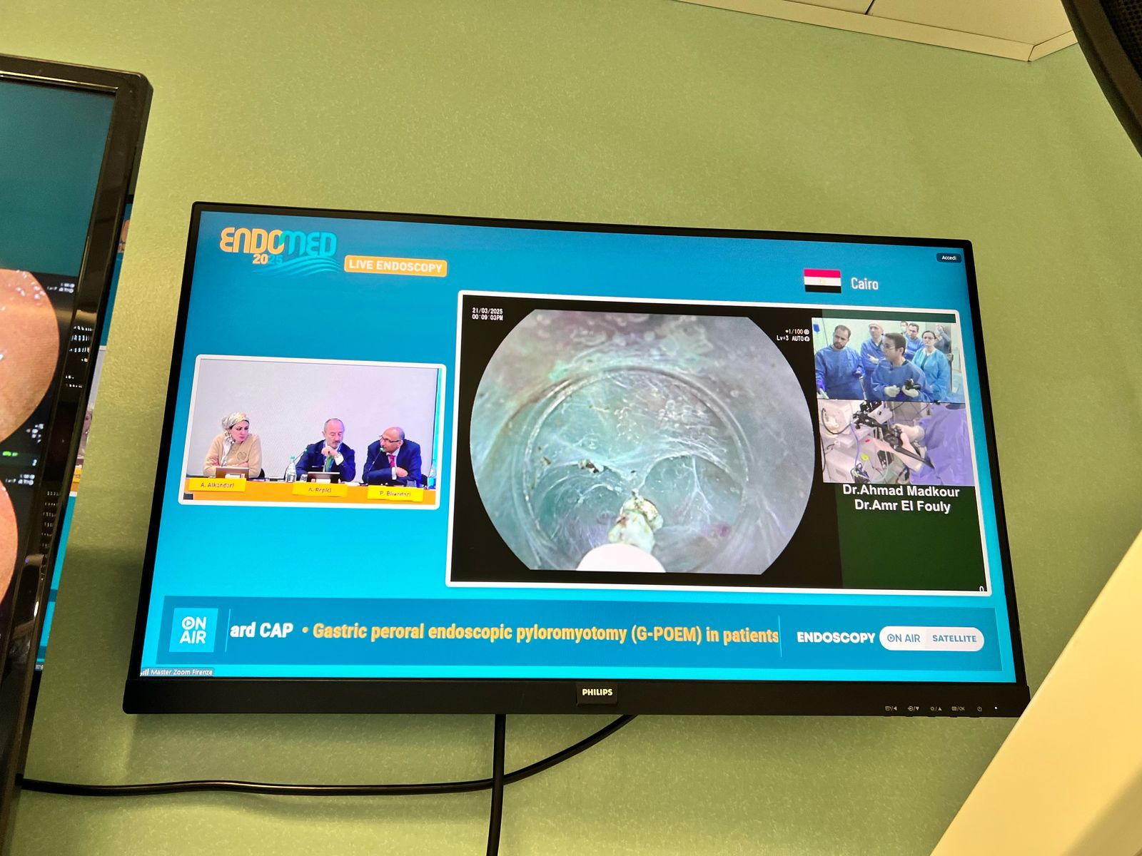 جامعة حلوان تحقق إنجازًا طبيًا عالميًا وإشادة دولية لبث حي لجراحة نادرة بالمنظار 