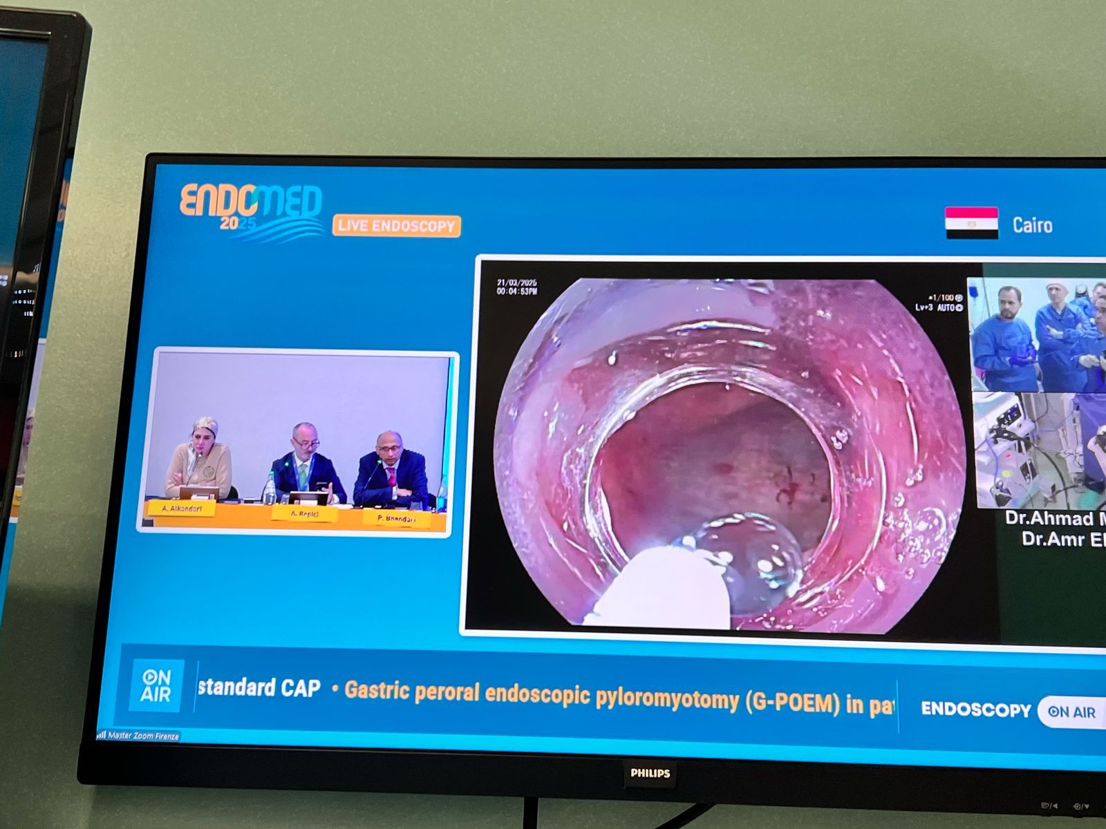 جامعة حلوان تحقق إنجازًا طبيًا عالميًا وإشادة دولية لبث حي لجراحة نادرة بالمنظار 