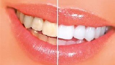 هل تعاني من اصفرار الاسنان ؟..جربي هذه الطريقة