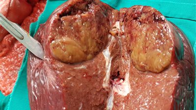 بالصور.. فريق جراحة كبد المنوفية ينجح فى استئصال ورم خبيث بالمعدة والكبد