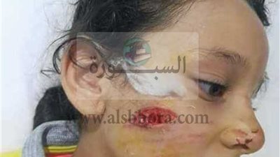 «تعليم الإسكندرية» تكشف كواليس  واقعة «عقر كلب ضال لتلميذة»