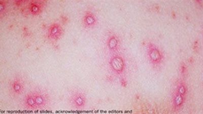 تعليم الجيزة: حالات الاصابة بمرض الجدري المائي  في مدرسه واحده وتم السيطره عليها 