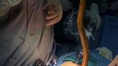 فيديو خطير .. لحظة استخراج ثعبان من أمعاء مريض