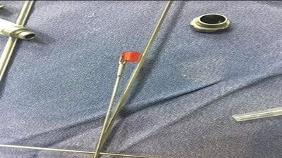 مستشفى بنى سويف الجامعى تنجح فى استخراج جسم غريب لطفلة 