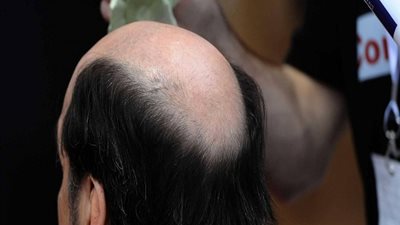 للصلع اسباب غير مألوفة