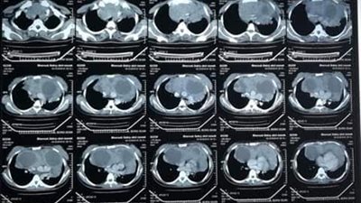 بالصور.. استئصال ورم وزنه 7 كيلو من صدر فتاة فى مستشفيات جامعة قناة السويس  