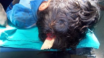 استخراج خشبة من مخ طفل بمستشفى الأقصر الدولي