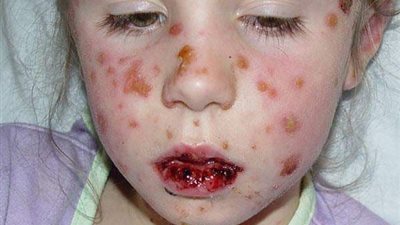 عاجل.. هانى الناظر يحذر من تناول اقراص القضاء على الديدان لتلاميذ الابتدائى تؤدى الى الوفاة 