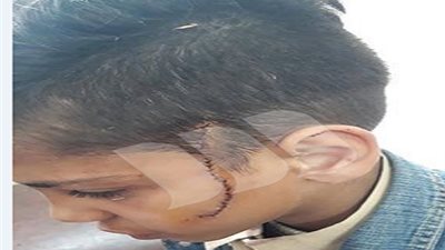 مشاجرة بسلاح ابيض بين طالبين بالابتدائى تسفر عن 30 غرزة فى الوجه