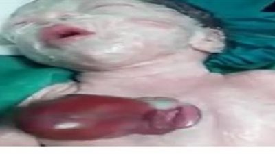 سيدة بسوهاج تضع 3  توائم  بينهم طفلة قلبها خارج جسدها .. والتواصل مع مجدي يعقوب لإجراء جراحة عاجلة