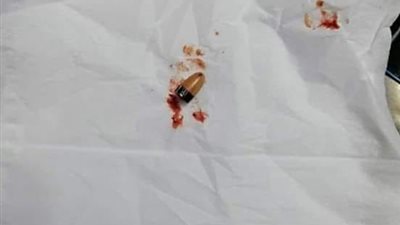 إستخراج سماعه دقيقة من أذن طالب بالثانوية العامه بعد إنزلاقها بداخل أذنه أثناء محاولته الغش بها 