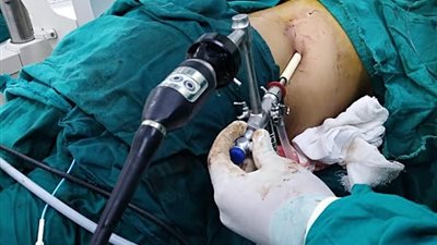 إجراء أول منظار كلي لتفتيت واستخراج حصوات بمستشفى سوهاج العام