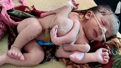 صدمة طبية.. ولادة طفلة بأربع أرجل و3 أياد