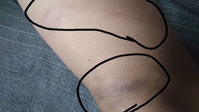 مدير مدرسة بأسوان يمزق جسد طالب بالخرطوم بسبب الحمام.. صور 