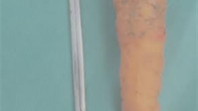 طبيب بقنا يستخرج 