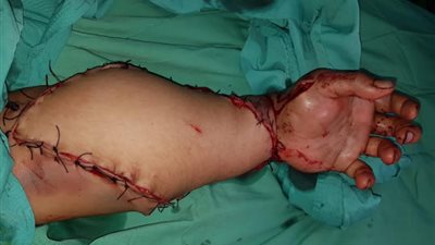 الجراحات الميكروسكوبية بمستشفيات قنا الجامعية تنقذ ذراع سيدة من البتر