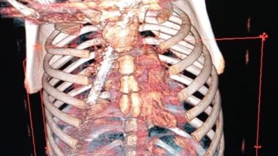 معجزة طبية تنقذ حياة طفل من الموت بمستشفي طنطا الجامعي 