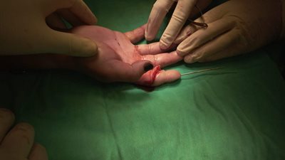 جراحة دقيقة تنجح فى إصلاح وتر مقطوع لطفلة بالمستشفي التعليمى بطنطا