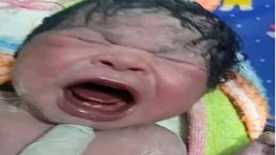 حالة ولاد نادرة شهدتها بسوهاج.. ربة منزل تضع مولودة بسنتين في فكها السفلي