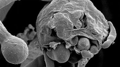 استشاري مناعة توضح خطورة الفطر الأبيض على الرئة وعلاقته بكورونا