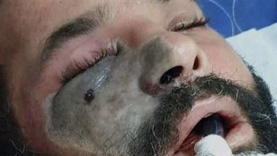 العليا للفيروسات تعلن بشرى سارة بشأن الفطر الأسود فى مصر