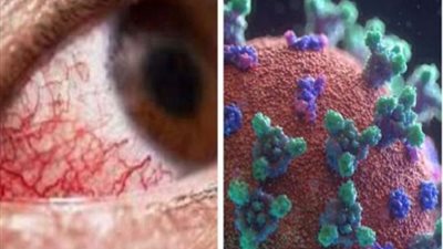 أول رد رسمى حول تجهيز غرفة لعزل مصابي الفطر الأسود