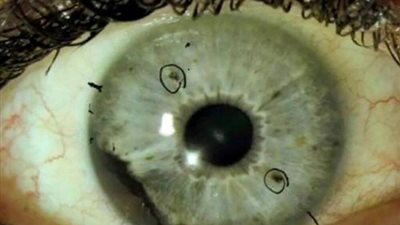 الصحة تعلن أسباب الإصابة بمرض الفطر الاسود.. وطرق انتقال العدوى والوقاية