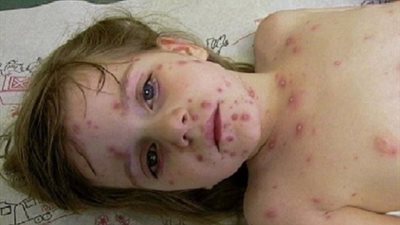 ظهور 16 حالة جديري مائي  بدمياط..ومنح الطلاب 15 يوما اجازة 
