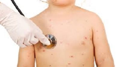 التعليم : اصابة 32 حالة بالجديري بسوهاج واسيوط ..و5 تلاميذ بالغدة النكافيةبالاقصر