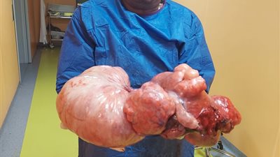 بالصور.. عملية استئصال ناجحة ورم مع الرحم والمبايض لمريضة بمدينة دشنا