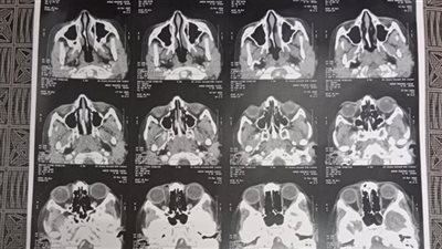 استخراج قلم جاف من تجويف عين طفل في محافظة الشرقية