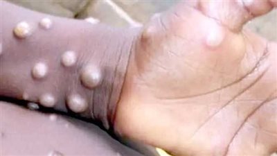 بيان عاجل من الصحة بشأن ايجابية حالة مصابة بفيروس جدرى القرود