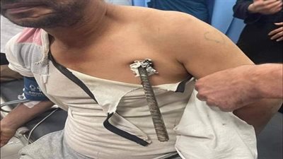 نجاح فريق طبي بمستشفى طوارئ قصر العينى فى استخراج 