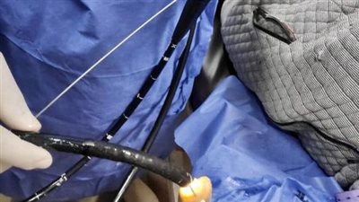 فريق طبي ينجح في استخراج هاتف محمول من معدة شاب بمستشفى الطوارىء الجامعى بطنطا