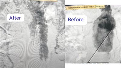 نجاح جديد لمستشفى بدر الجامعى فى إجراء تركيب قسطرة دقيقة بواسطة فريق جراحة الأوعية الدموية