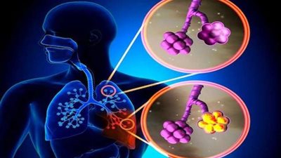 أسباب الالتهاب الرئوي وأعراضه وكيفية الوقاية منه في 4 خطوات