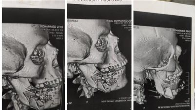 أخبار الجامعات|مستشفى سوهاج الجامعي تنجح في إجراء عملية جراحية لمصاب بطلق ناري بعظام الرقبة