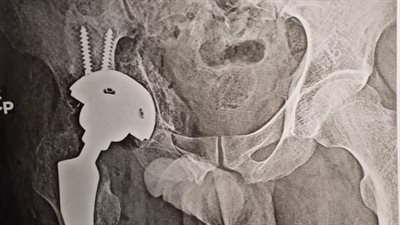 إجراء عملية تركيب مفصل كامل لأحد مصابي غزة بمستشفي سوهاج الجامعي