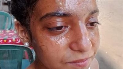 كوب الشاى تحول الى كابوس..شوه وجه تلميذة  داخل مدرسة خاصة بالجيزة 