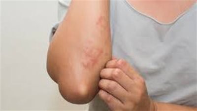 أسباب ظهور الطفح الجلدي في الشتاء.. كيفية الوقاية والعلاج منه