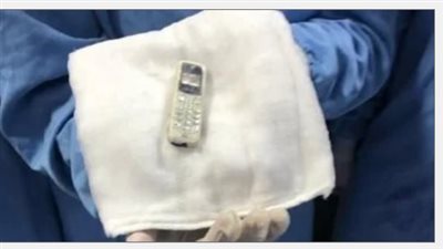 استخراج هاتف محمول من معدة مريض ظل بداخله 6 سنوات في المنصورة