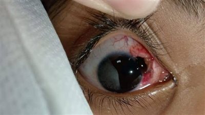 لهيب العيد يحرق عيون الصغار..مستشفى سوهاج الجامعي في مواجهة كارثة الألعاب النارية