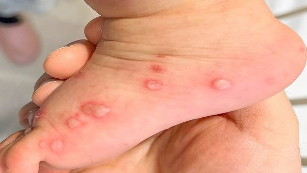 مرض اليد والقدم والفم