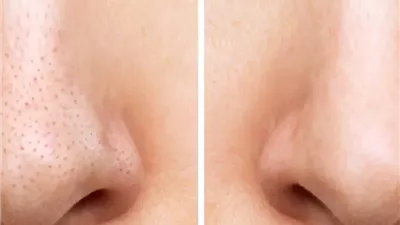 كيفية التخلص من الرؤوس السوداء.. نصائح فعّالة لبشرة نضرة خالية من العيوب