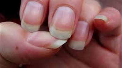 الأظافر تكشف أمراضك.. 7 علامات خطيرة يجب مراقبتها