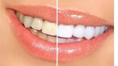 أسباب وطرق علاج إصفرار الأسنان